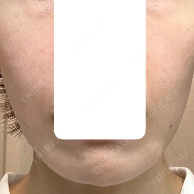 肌育注射（ジュベルックなど） 城本クリニック 長崎院 DAY 0 メイン用