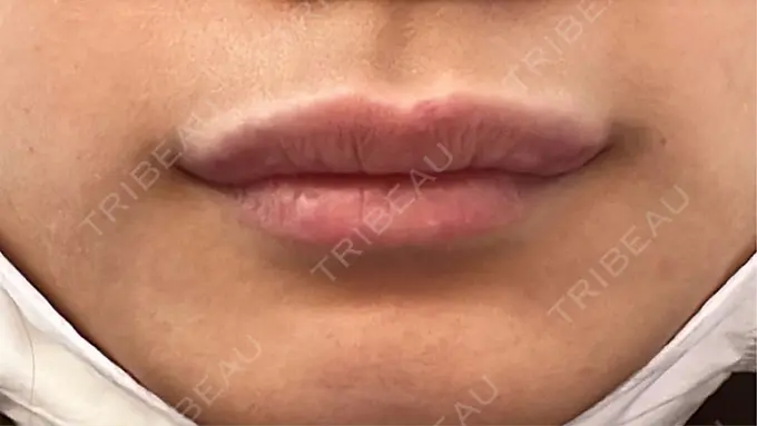 ヒアルロン酸注入（唇） / ボトックス（口角） ルラ美容クリニック 高田馬場院 DAY 1 メイン用