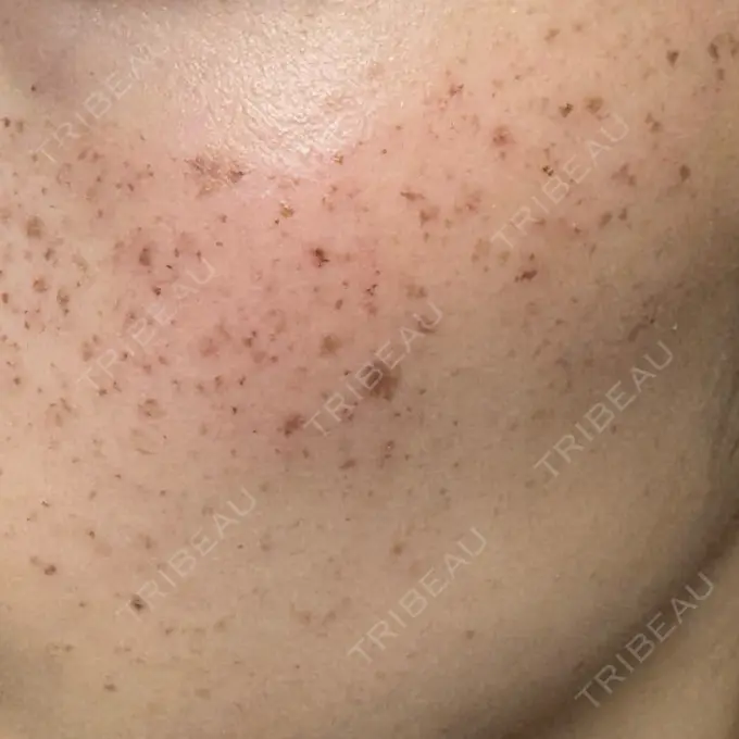 ルメッカ ルラ美容クリニック 高田馬場院 DAY 0 メイン用