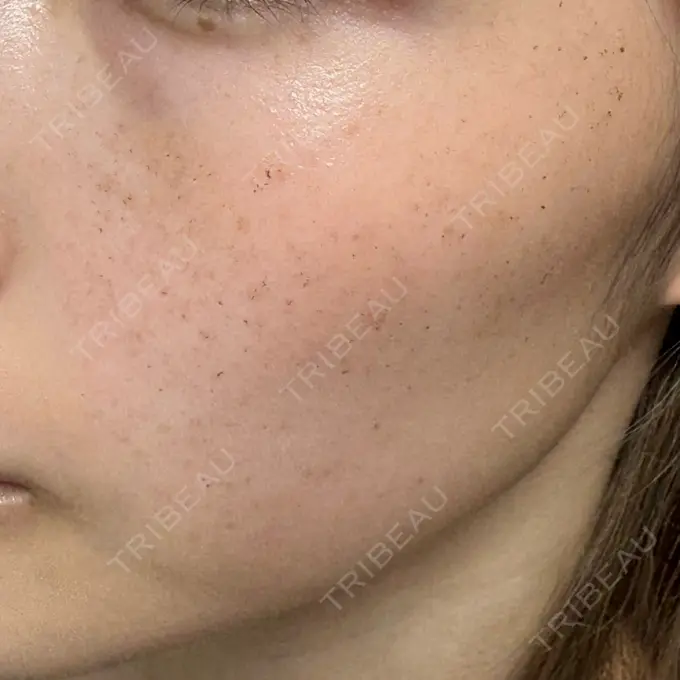 ルメッカ ルラ美容クリニック 高田馬場院 AFTER メイン用