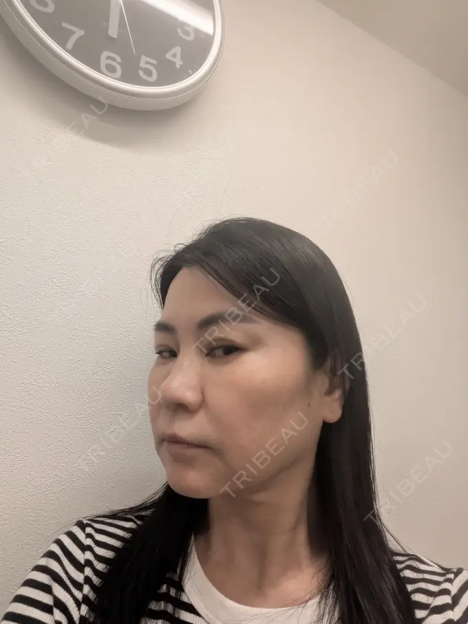 ボトックス（エラ・小顔） TCB東京中央美容外科 松山院 DAY -5 メイン用