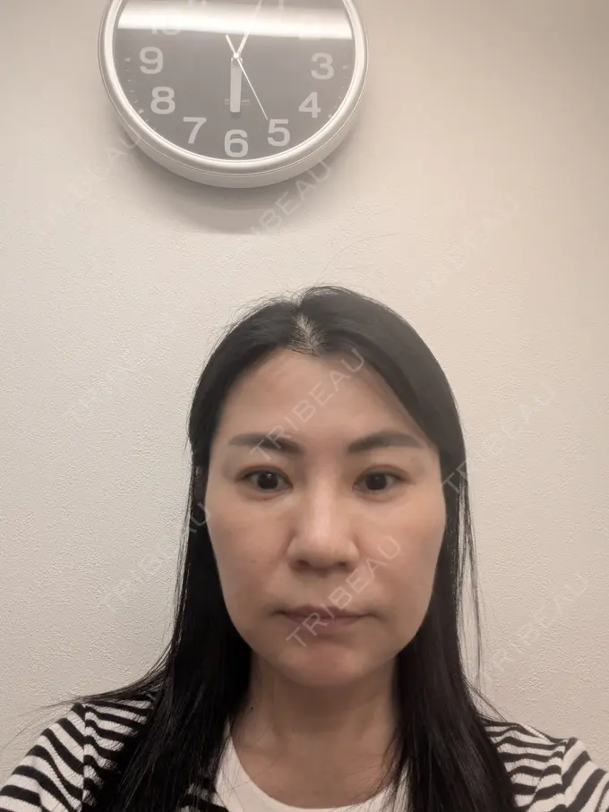 ボトックス（エラ・小顔） TCB東京中央美容外科 松山院 AFTER メイン用