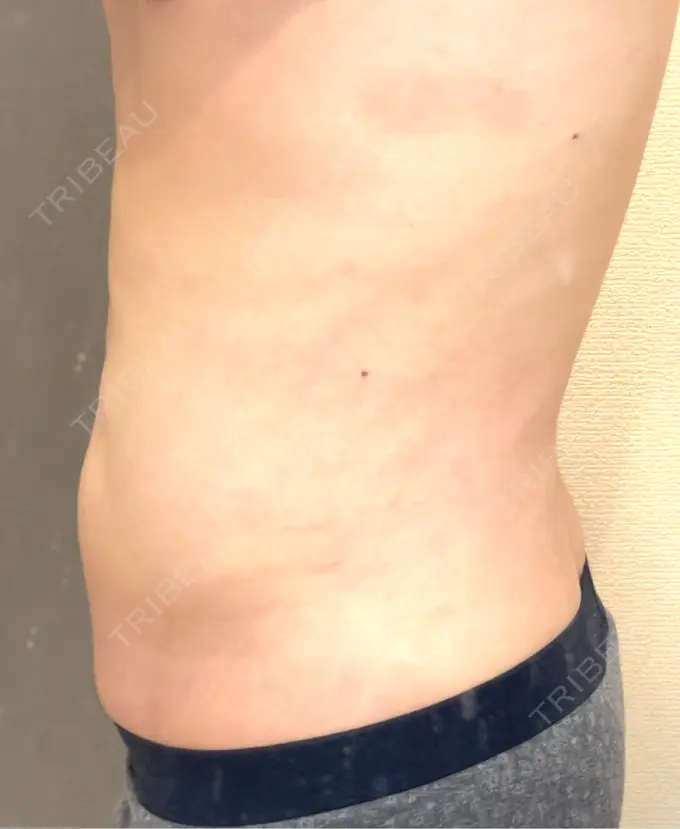 脂肪吸引（お腹） / 脂肪吸引（腰） オアシス美容外科 DAY 34 メイン用