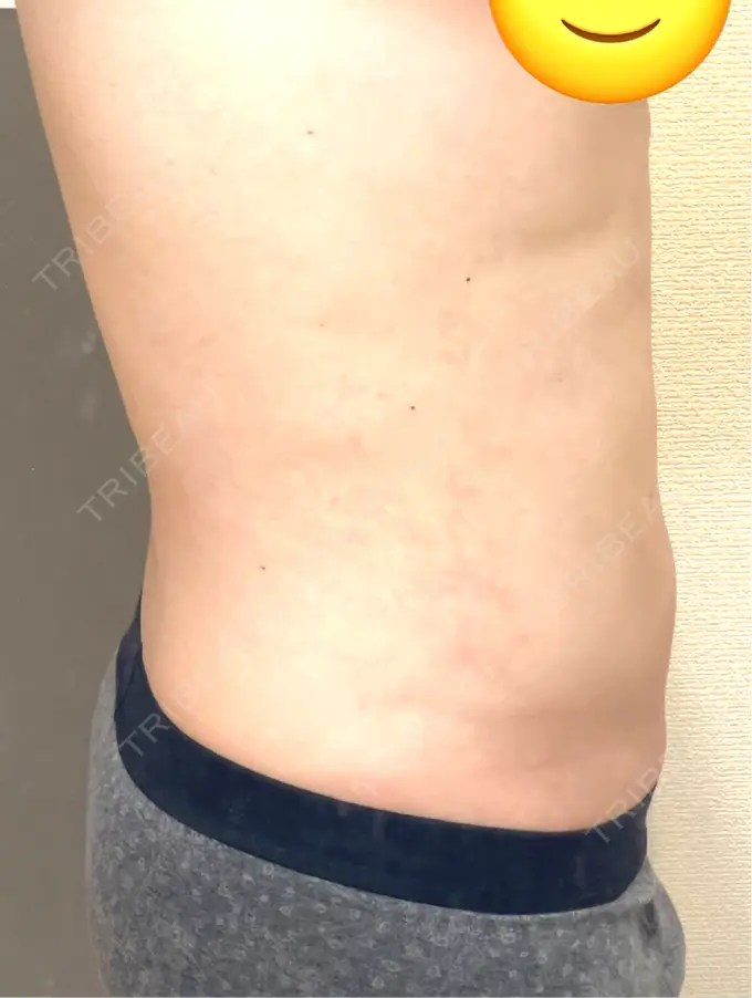 脂肪吸引（お腹） / 脂肪吸引（腰） オアシス美容外科 DAY 34 メイン用