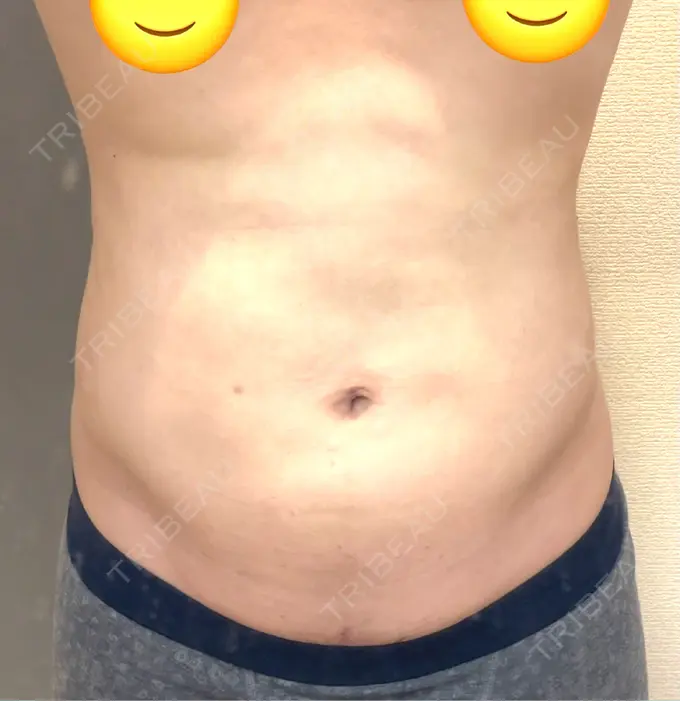 脂肪吸引（お腹） / 脂肪吸引（腰） オアシス美容外科 DAY 34 メイン用