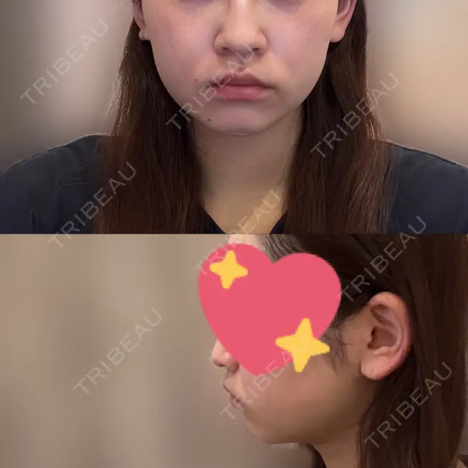 糸リフト / 脂肪吸引（顔） / ボトックス（あご） / ヒアルロン酸注入（あご） / ボトックス（エラ・小顔） / ヒアルロン酸注入（頬） / ヒアルロン酸注入（鼻翼基部） GRACIA clinic 【グラシアクリニック】 AFTER メイン用