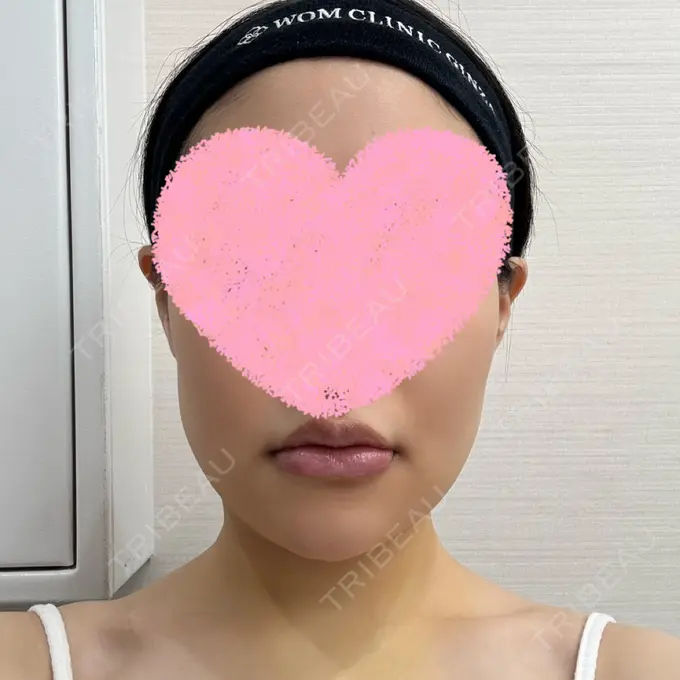 骨切り（あご） / 脂肪吸引（顔） WOM CLINIC GINZA （ワム クリニック ギンザ） DAY 7 メイン用