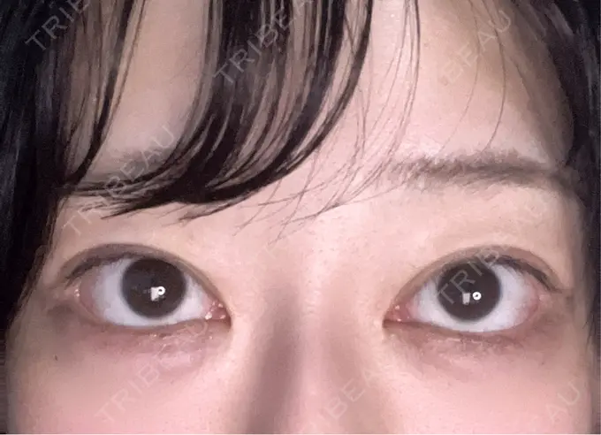 ヒアルロン酸注入（涙袋） / ボトックス（タレ目） アネシス美容クリニック AFTER メイン用