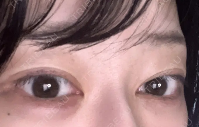 ヒアルロン酸注入（涙袋） / ボトックス（タレ目） アネシス美容クリニック DAY 0 メイン用