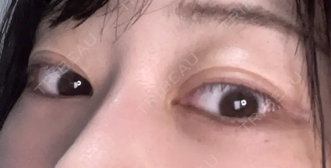 ヒアルロン酸注入（涙袋） / ボトックス（タレ目） アネシス美容クリニック DAY 0 メイン用