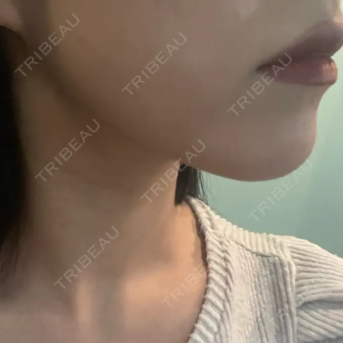 ハイフ（顔） エースクリニック 大阪梅田HEPナビオ院 DAY 1 メイン用