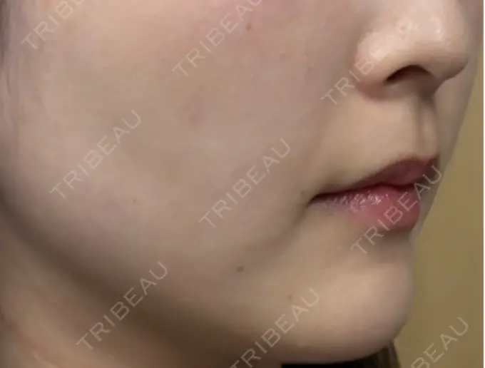 RF（高周波）たるみ治療 共立美容 池袋院 DAY 30 メイン用