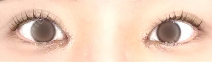 目頭切開 PRISM Beauty Clinic 町田院 DAY 7 メイン用