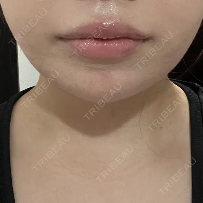 ボトックス（あご） / ヒアルロン酸注入（あご） / ボトックス（エラ・小顔） / ヒアルロン酸注入（唇） アリエル美容クリニック 横浜院 DAY 2 メイン用