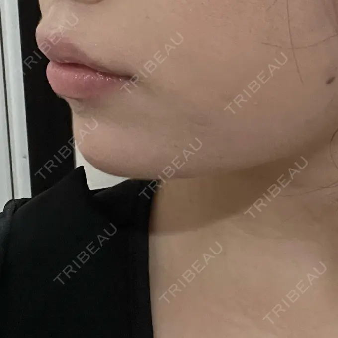 ボトックス（あご） / ヒアルロン酸注入（あご） / ボトックス（エラ・小顔） / ヒアルロン酸注入（唇） アリエル美容クリニック 横浜院 DAY 2 メイン用