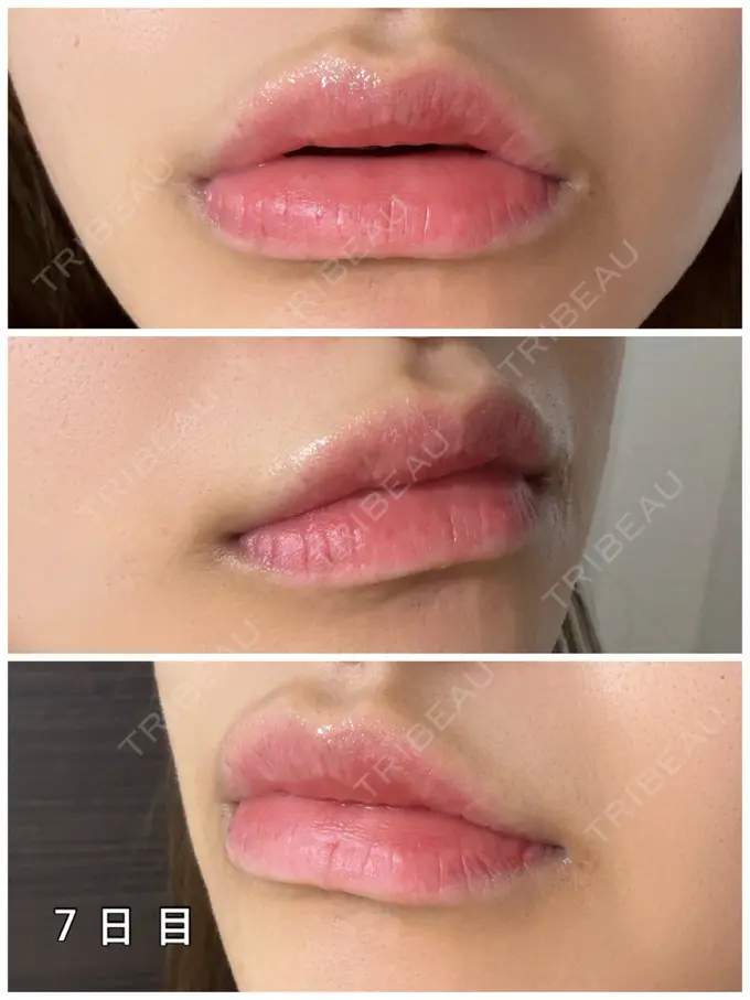 アートメイク（唇） 筋肉・美容クリニック AFTER メイン用