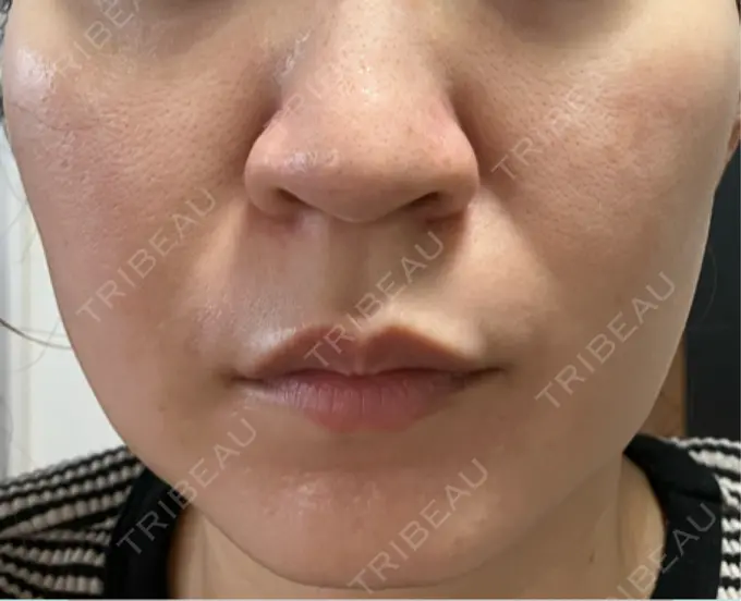 医療脱毛（顔） 渋谷美容外科クリニック 横浜院 DAY 3 メイン用