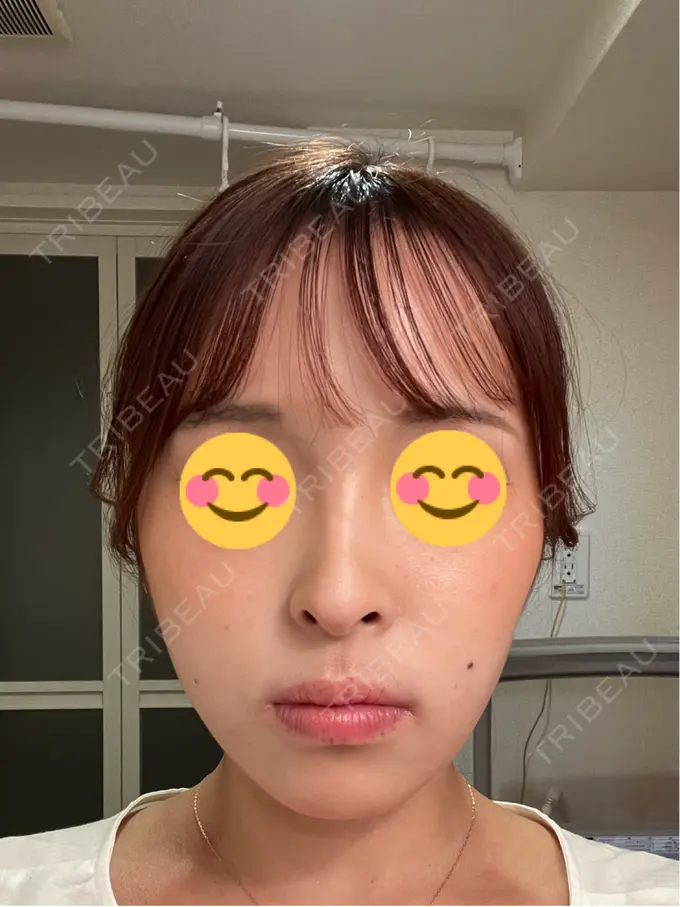 その他（肌） / ピーリング（ニキビ・毛穴） / 光治療（フォトフェイシャルなど） / ピーリング（ハリ・ツヤ） / ルメッカ BITO BEAUTY CLINIC DAY 8 メイン用