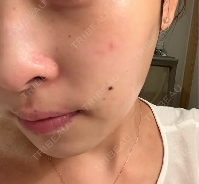 その他（肌） / ピーリング（ニキビ・毛穴） / 光治療（フォトフェイシャルなど） / ピーリング（ハリ・ツヤ） / ルメッカ BITO BEAUTY CLINIC DAY 8 メイン用