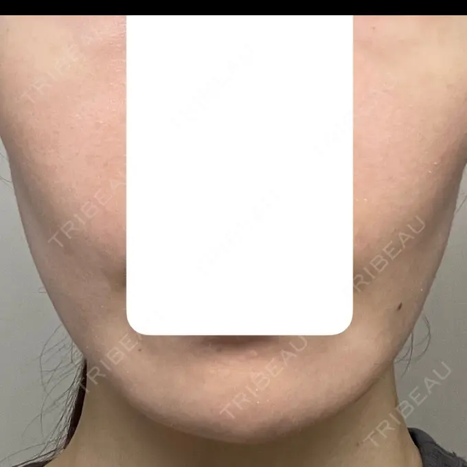 肌育注射（ジュベルックなど） 城本クリニック 長崎院 DAY 1 メイン用