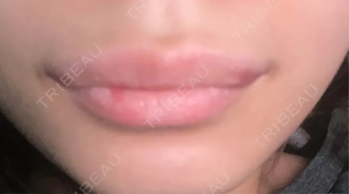 ヒアルロン酸注入（唇） / ボトックス（口角） ルラ美容クリニック 高田馬場院 DAY 2 メイン用