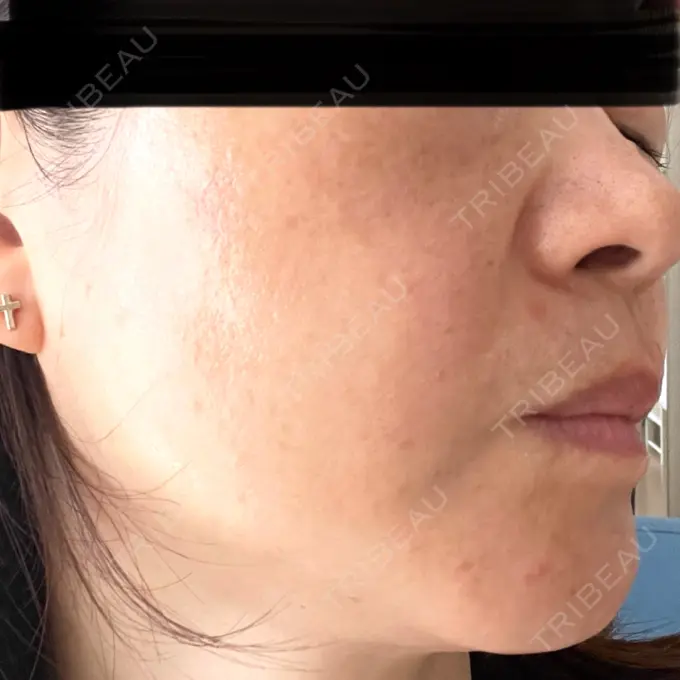 ピコレーザートーニング（美白・肝斑） / ピコスポット 東京シルククリニック 東京神田院 AFTER メイン用