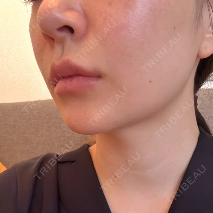 肌ヒアルロン酸注入（たるみ・シワ改善） / ヒアルロン酸注入（唇） 東京シルククリニック 東京神田院 DAY 7 メイン用