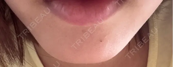 ボトックス（あご） ルラ美容クリニック 神戸院 AFTER メイン用