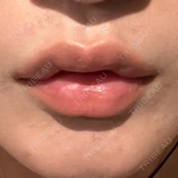 ヒアルロン酸注入（唇） / ボトックス（口角） ルラ美容クリニック 高田馬場院 AFTER メイン用