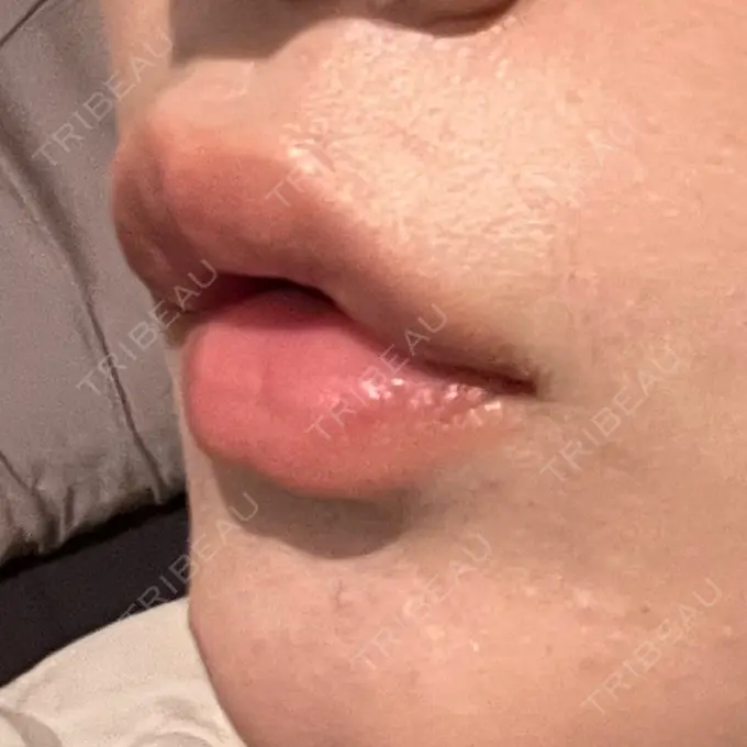 ヒアルロン酸注入（唇） / ボトックス（口角） ルラ美容クリニック 高田馬場院 DAY 2 メイン用