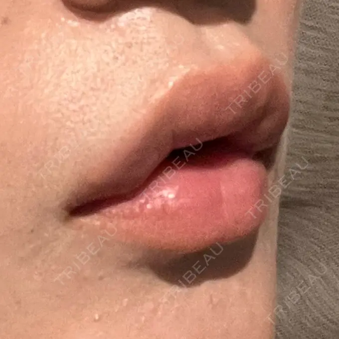 ヒアルロン酸注入（唇） / ボトックス（口角） ルラ美容クリニック 高田馬場院 DAY 2 メイン用