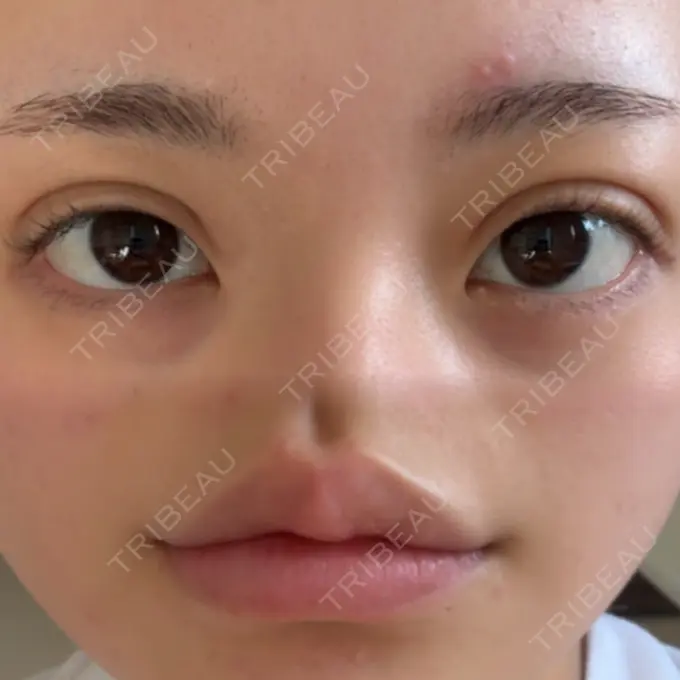 二重埋没 / ヒアルロン酸注入（唇） アリエル美容クリニック 横浜院 DAY 2 メイン用