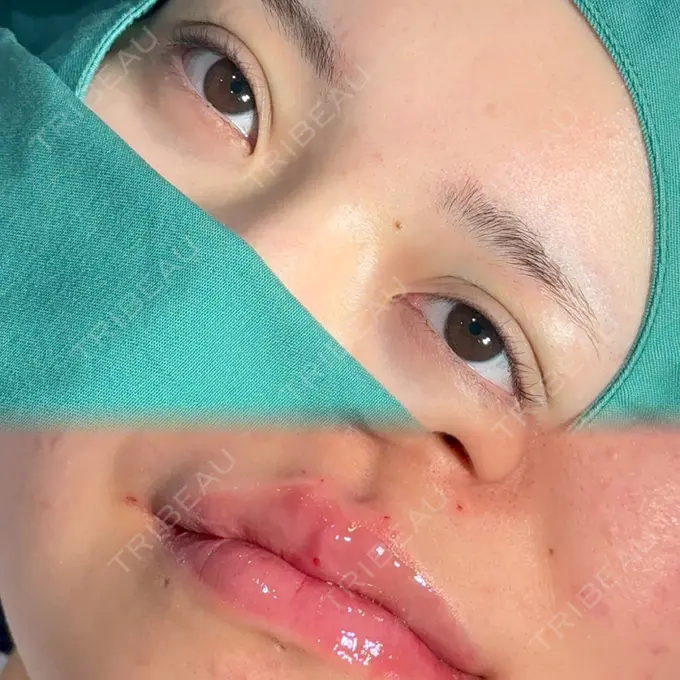 二重埋没 / ヒアルロン酸注入（唇） アリエル美容クリニック 横浜院 DAY 0 メイン用