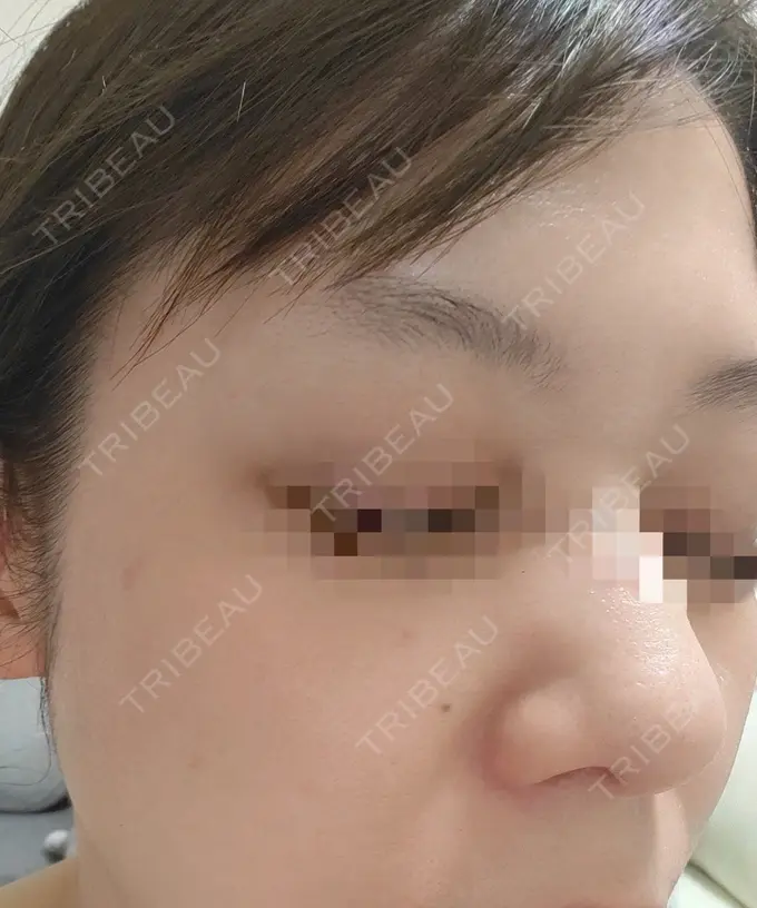 ピコスポット APスキンクリニック銀座 DAY 1 メイン用