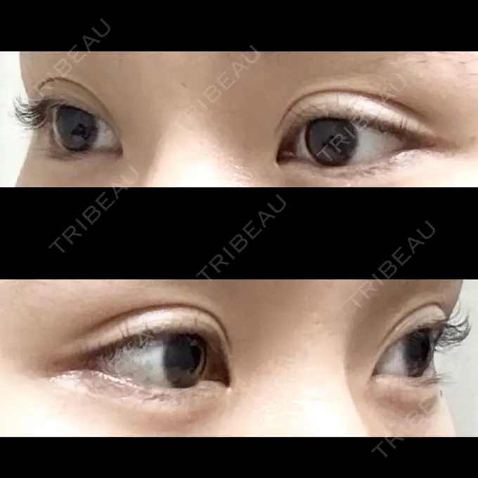 二重埋没 ドクター松井クリニック 新宿 DAY 15 メイン用