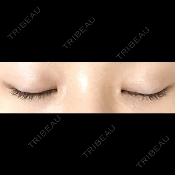 二重埋没 ドクター松井クリニック 新宿 DAY 15 メイン用