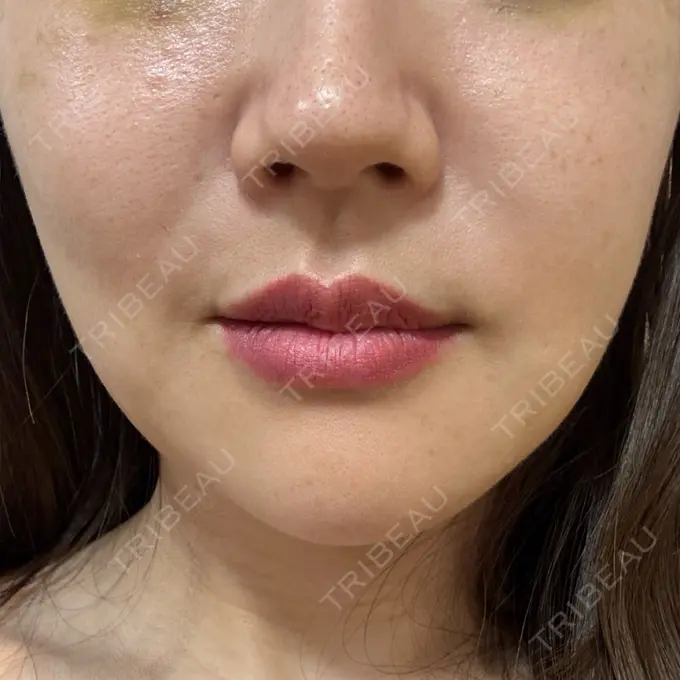 RF（高周波）たるみ治療 RIVER CLINIC（リバークリニック） DAY 6 メイン用