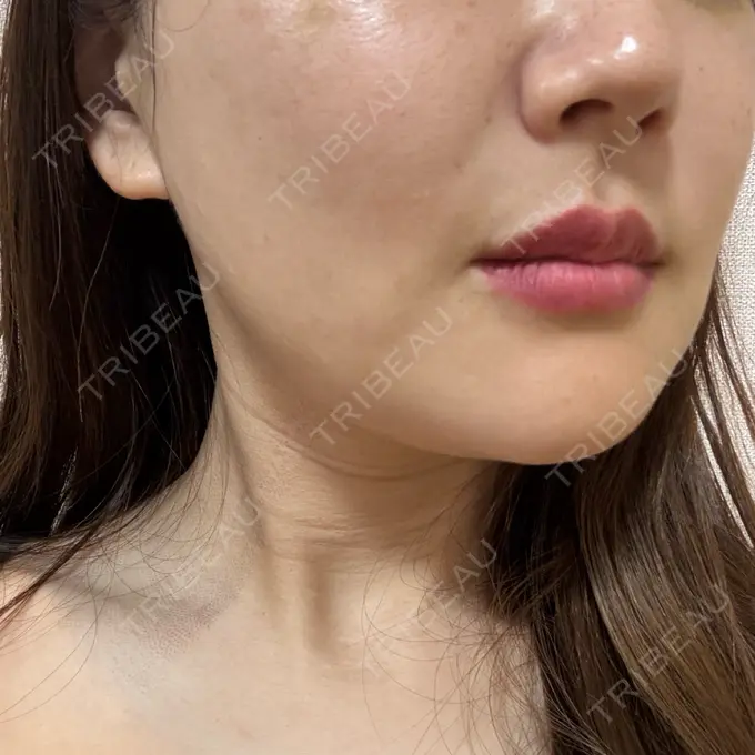 RF（高周波）たるみ治療 RIVER CLINIC（リバークリニック） DAY 6 メイン用