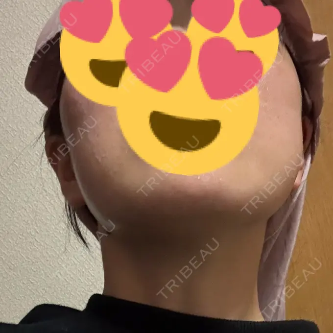 RF（高周波）たるみ治療 / その他（輪郭） Clinic K Blossom DAY 25 メイン用