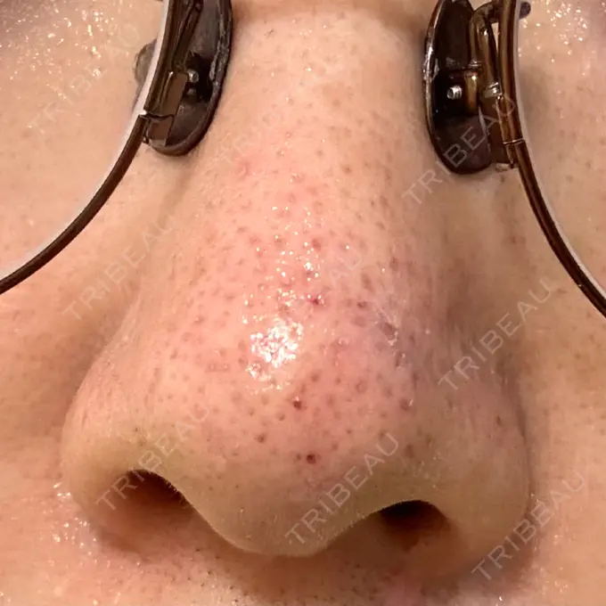 アグネス 日本美容・医療クリニック 六本木院 DAY 3 メイン用