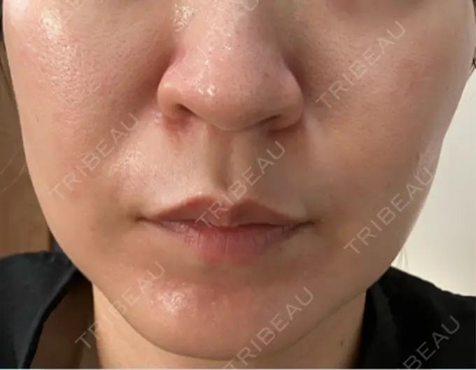 医療脱毛（顔） 渋谷美容外科クリニック 横浜院 DAY 4 メイン用