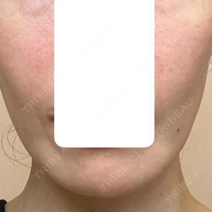 肌育注射（ジュベルックなど） 城本クリニック 長崎院 DAY 2 メイン用