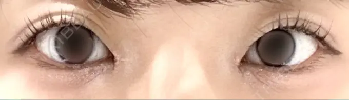 目頭切開 PRISM Beauty Clinic 町田院 DAY 9 メイン用