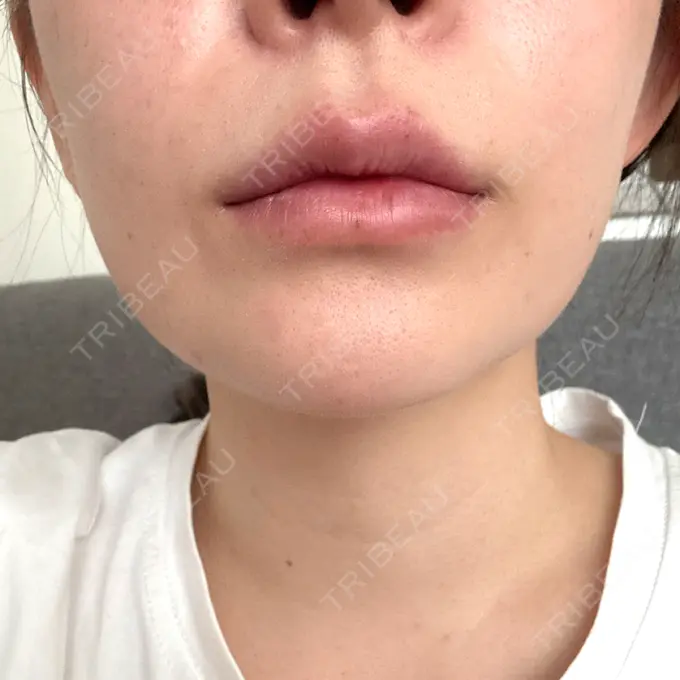 肌ヒアルロン酸注入（たるみ・シワ改善） / ヒアルロン酸注入（唇） 東京シルククリニック 東京神田院 DAY 8 メイン用