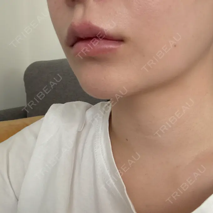 肌ヒアルロン酸注入（たるみ・シワ改善） / ヒアルロン酸注入（唇） 東京シルククリニック 東京神田院 DAY 8 メイン用