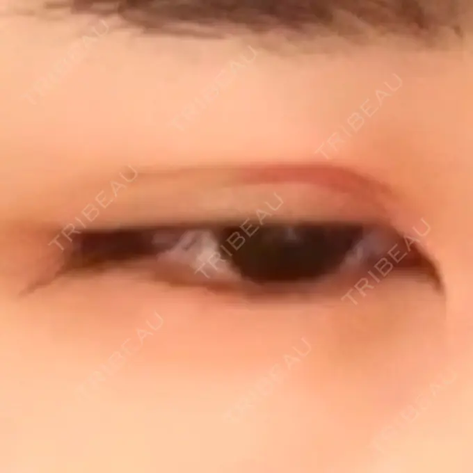 二重切開 よこはまエーブクリニック DAY 36 メイン用