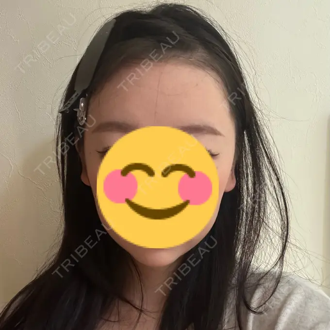 ボトックス（エラ・小顔） HAAB BEAUTY CLINIC 名古屋院 AFTER メイン用