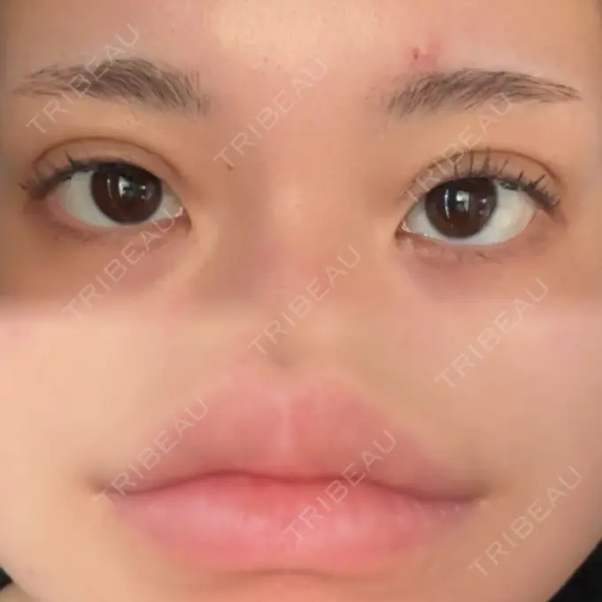 二重埋没 / ヒアルロン酸注入（唇） アリエル美容クリニック 横浜院 DAY 3 メイン用