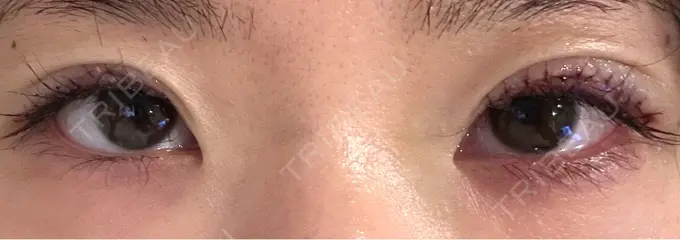 上まぶたたるみ取り / 目元修正 BIANCA銀座 DAY 0 メイン用