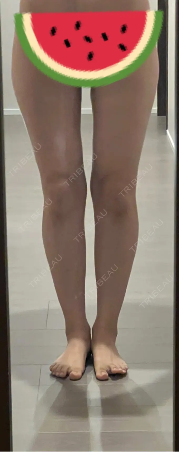 脂肪吸引（脚） / 脂肪吸引（お尻） Mods Clinic（モッズクリニック） 名古屋院 AFTER メイン用